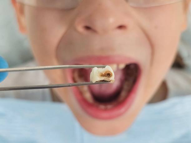 Best Emergency Tooth Extraction in Kermit, TX
